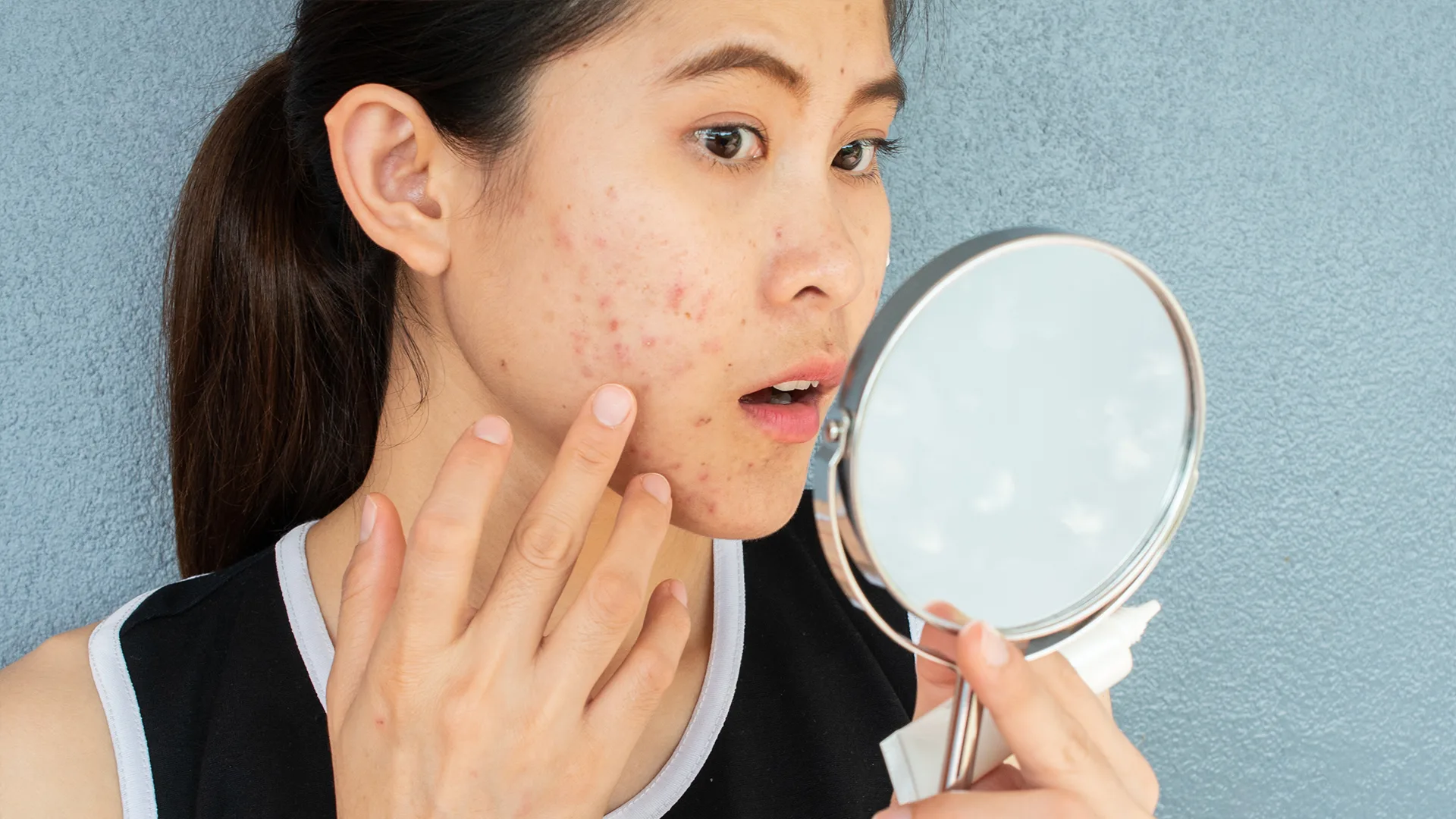 I struggle with post-acne spots – my $10.90 buy faded them in a month, I don’t recognize myself in the mirror anymore